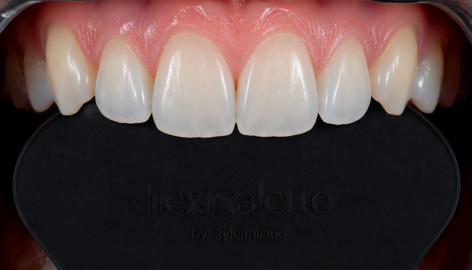 هنرِ حذف نویزها در عکاسی دندانپزشکی: چرا فلکسی‌پلت (Flexipalette) فراتر از یک تضاد ساده است؟